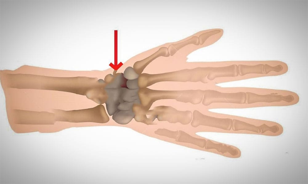 El Bileği Kırıkları Nedenleri
